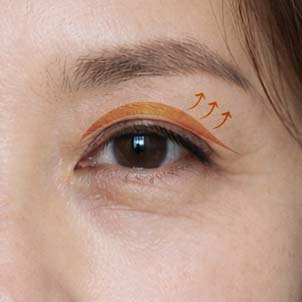 처진 눈가 탄력 개선