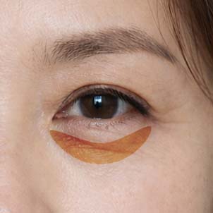 눈 밑 지방 개선