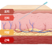 스킨보톡스